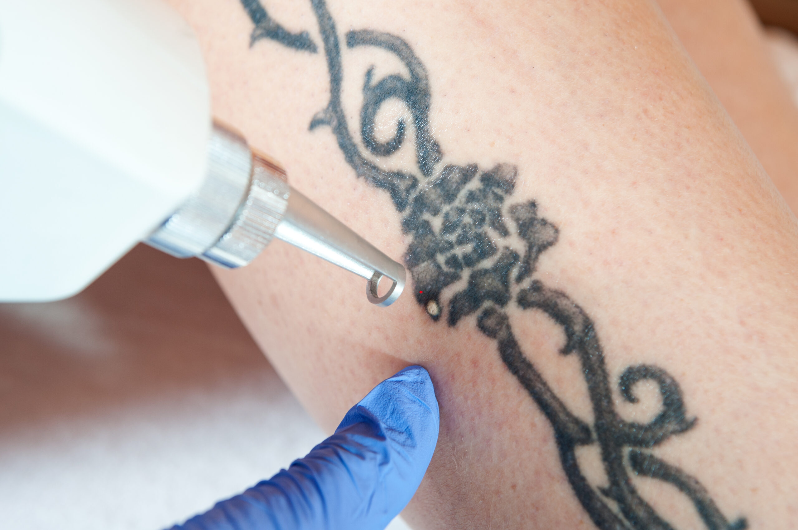 Tattoo Removal