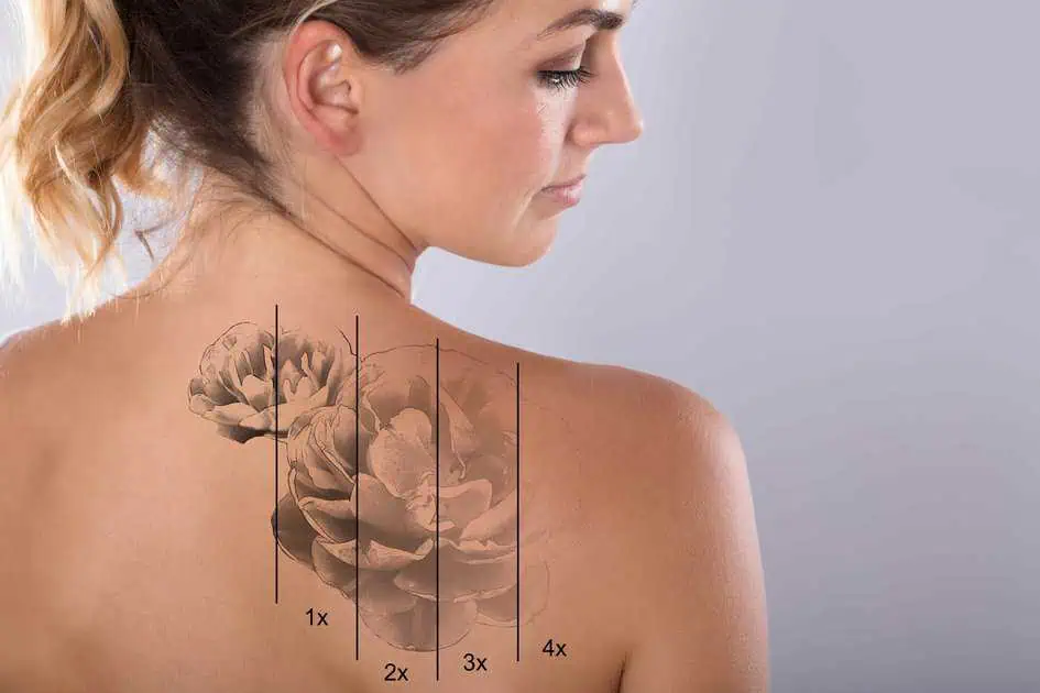 Tattoo Lightening Treatment by Renewal Tattoo Removal in Raleigh, NC