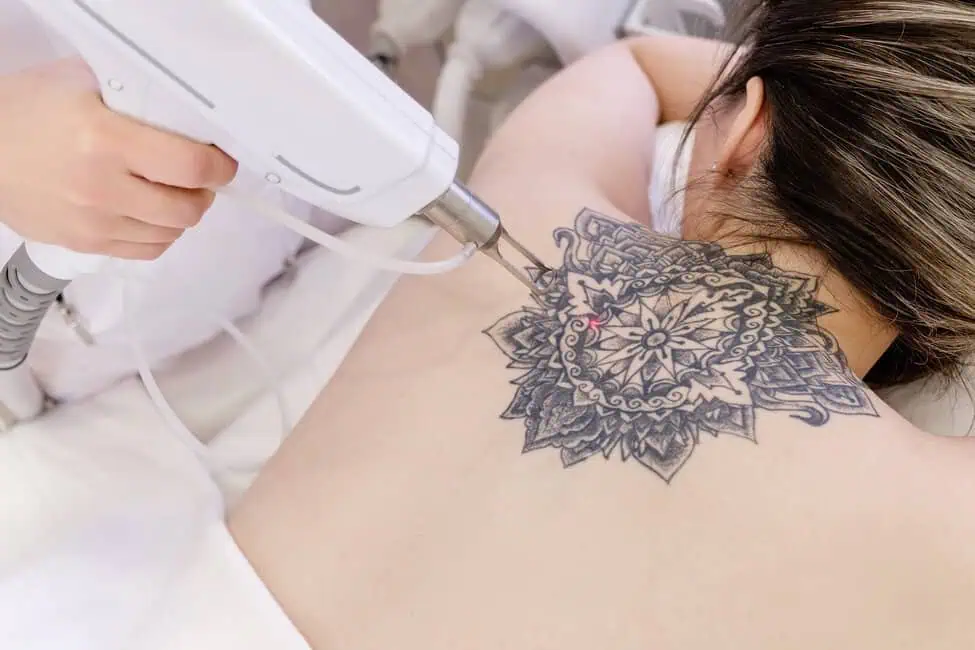 Tattoo Removal by Renewal Body Contouring LLC in Raleigh, NC