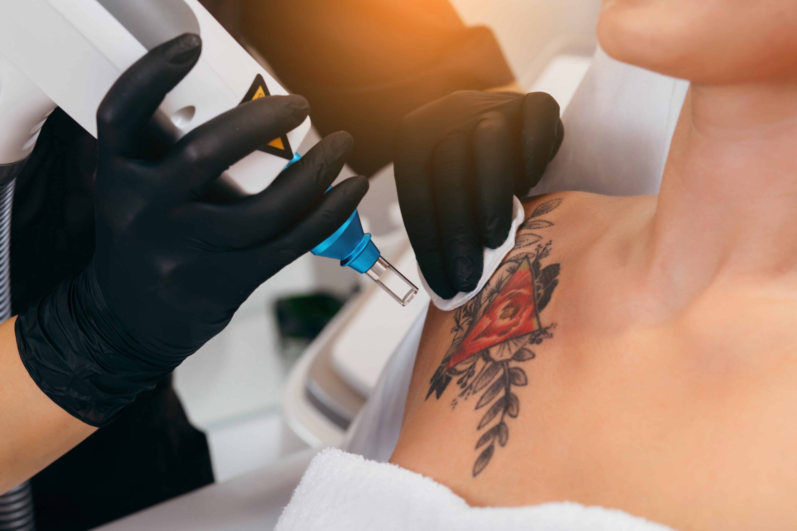 Tattoo Removal by Renewal Body Contouring LLC in Raleigh, NC