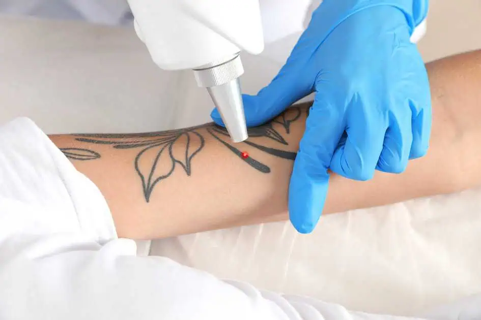 Tattoo Removal in Raleigh, NC by Renewal Body Contouring LLC