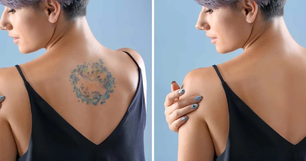 Woman showing before and after results with smooth, healed skin representing best Tattoo Removal in Raleigh, NC