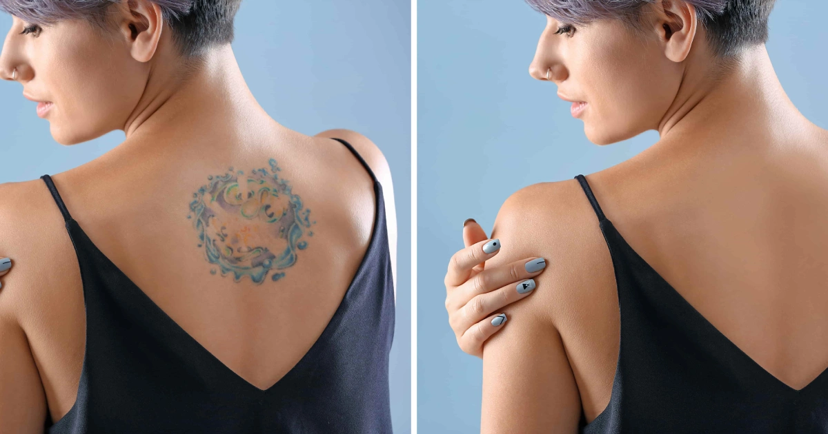 Woman showing before and after results with smooth, healed skin representing best Tattoo Removal in Raleigh, NC