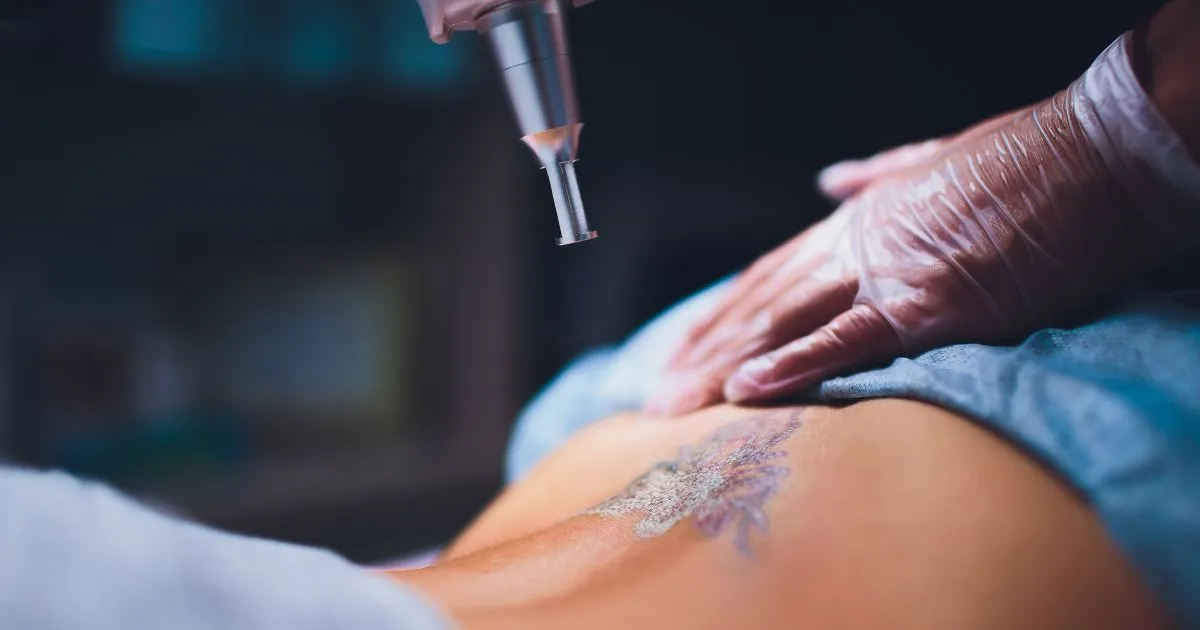 Professional Cosmetic Tattoo Removal procedure being performed in Raleigh, NC