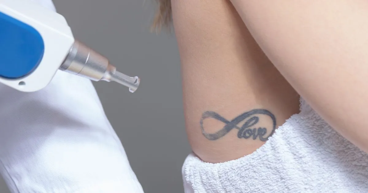 Laser Tattoo Lightening treatment on a patient’s skin in Raleigh, NC